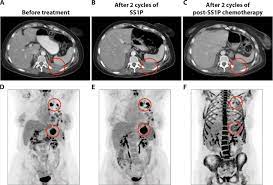 This is called familial pancreatic cancer. Major Cancer Regressions In Mesothelioma After Treatment With An Anti Mesothelin Immunotoxin And Immune Suppression Science Translational Medicine