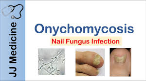 Image result for onychomycosis