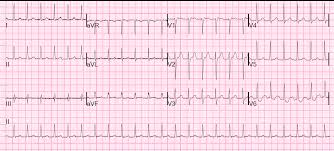 Paroxysmal supraventricular tachycardia (psvt) is the most common of these arrhythmias and the one that is most often encountered in the primary care setting. Dr Smith S Ecg Blog An Apparent Svt That Does Not Persistently Correct With Adenosine