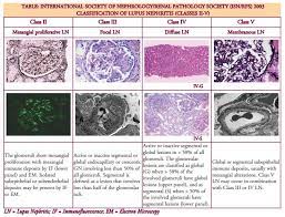 Classification Of Lupus Nephiritis Table Http Www Propath Com Companies Press Clippings 26 Newsletters 228 Classification Of Lupus Nephritis An Update March 2