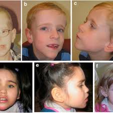 Pedigree and aCGH data shown