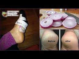 After This You Will Go To Sleep With Onions In Your Socks Every Night Onion In Your Sock Onion In Sock Foot Remedies