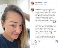 It sounds weird but it works great, she says. Two Celebrity Mums Speak Out About Postpartum Hair Loss Here Re What Other Moms Need To Know Motherhood In Style Magazine