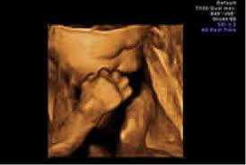 Beim 3d ultraschall handelt es sich nun auch um bilder, die man in dreidimensionaler form sehen kann. Schwangerschaft 3d 4d Ultraschall