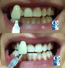 We did not find results for: Blanqueamiento Dental Clinica Dental Gil