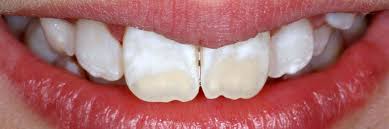 Image result for Tooth Discoloration