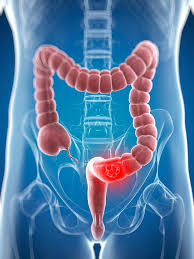 April is bowel cancer awareness month and mark flannagan, chief executive of the charity beating bowel cancer bowel cancer is currently the uk's second biggest cancer killer but it doesn't have to be that way because it can be successfully treated in nine out of ten cases if caught at an early stage. Bowel Cancer Symptoms Prevention And Treatment Essential Facts Mirror Online