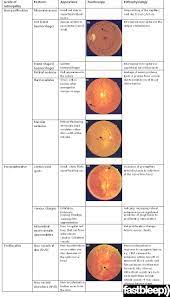 Diabetic Retinopathy Eye Health Eye Facts