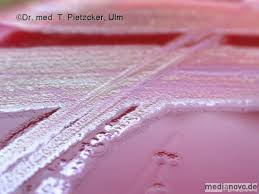 Pseudomonas infections occur due to a specific type of bacteria and can affect different areas of the body. Diagnostik Universitatsklinikum Ulm
