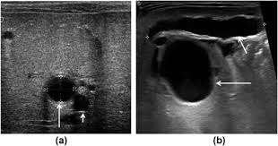 Biliary atresia is a uniquely perinatal disease that 30 years ago would have been universally fatal. The Role Of Ultrasound In The Investigation Of Neonatal Jaundice Clinical Radiology