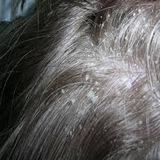 How To Get Rid Of Dry Scalp Flakes Dry Scalp Remedy Dry Scalp Treatment Oils For Dandruff