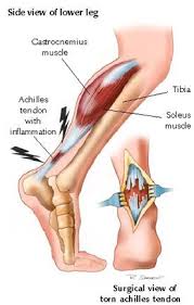 Leg pain can often be treated at home, but if pain is sudden, severe, or persistent, or if there are a strain is an injury to the muscles or tendons. Achilles Tendon Injury Active Care Physiotherapy Clinic