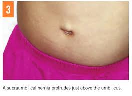 Image result for Umbilicus