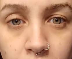 What are the best home remedies for a swollen eyelid?