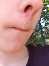 Fieberblase In Der Nase