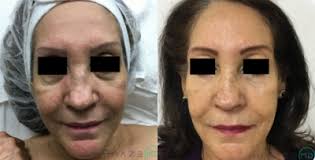 RealSelf: Aileen Caceres, MD, FACOG, FACS