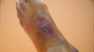 Pain might not be associated with the bite, but a small hard area may. Hobo Spider Bite Pictures Symptoms And Treatments