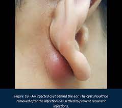 Update your find a dermatologist profile, the academy's directory that's visited by over 1 million people a year. Ear Lumps Bumps Dr Gan Eng Cern