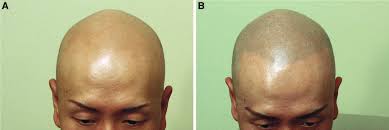 Alopecia and its association with coronary heart disease and cardiovascular risk factors: Patient With Alopecia Totalis Having Smp To Create A Normal Appearing Download Scientific Diagram