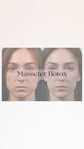 It’s time for another Teller Talk! *wait til the end for results* Dr. Craig  Teller, co-owner of Bellaire Dermatology, talks about masseteric  hypertrophy. He discusses how Botox can help slim enlarged ...