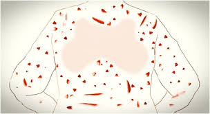 Image result for Neurotic Excoriation