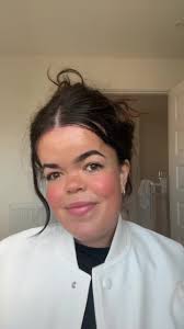 One Month Update: Hairline Lowering Surgery and Forehead Reduction