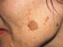 This leaflet contains information on how to spot the symptoms of skin cancer early and reduce your risk. Age Spots Stratum Dermatology Clinics