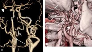 The carotid arteries supply blood to the large, front part of the brain, where thinking, speech, personality and sensory and motor. Anastomosis Of The External Carotid Artery And The V3 Segment Of The Vertebral Artery Presumed Persistent Second Cervical Intersegmental Artery Diagnosed By Ct Angiography Springerlink