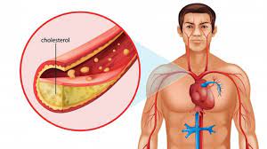 Un scor sub 200 este normal. Ce Este Colesterolul Care Sunt Valorile Normale Si De Risc Ale Colesterolului
