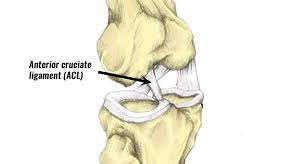 An access control list (acl) contains rules that grant or deny access to certain digital environments. Acl Tear Anterior Cruciate Ligament Sprain Diagnosis Rehabilitation