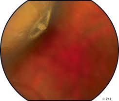 It may be done right in your ophthalmologist's office. Peripheral Retinal Degenerations And Rhegmatogenous Retinal Detachment Ento Key