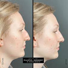 Non-Surgical Rhinoplasty or "Non-Surgical Nose Job" is a quick way to  smooth the contour of the nose. Dr. Adams adds Dermal Filler to smooth the  nasal bridge. These "after" photos are taken