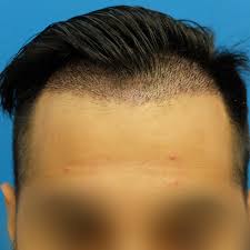 An fue hair transplant can be undergone in either one long session or several smaller sessions. Hair Transplant Side Effects What Are They How Long Do They Last