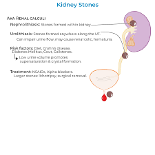 Image result for Nephrolithiasis