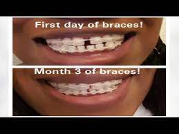 Closing molar spaces is very tough. 7 My Braces Journey Mini Braces Update Gaps Closing Vlogging My Adjustment Day Youtube