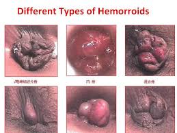 Résultat de recherche d'images pour "hemorrhoids?"