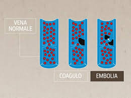 Trombosi venosa è quando il coagulo di sangue blocca una vena. Cos E La Trombosi E Quali Sono Le Cause Corriere It