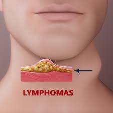 Early symptoms may include heartburn, upper abdominal pain, nausea. Best Cancer Hospital In India Lymphoma Cancer Treatment In Coimbatore Tamil Nadu