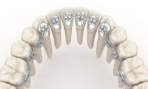 It typically takes a week for patients to adjust to the new appliance with regard to eating, speaking and overall tongue comfort. How Much Do Lingual Braces Cost In Ct Greater Hartford Ortho