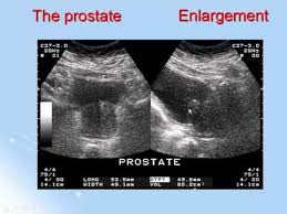 Ultrasound Of The Prostate Ultrasound Prostate Ultrasound Tech