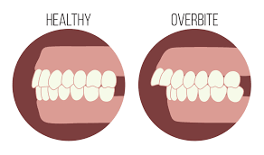 Can an overbite cause health problems? Overbite Or Buck Teeth The Steps To The Smile You Ve Always Wanted Sherman Balhoff