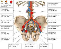 This is more commonly used to see if prostate cancer has come back after treatment, rather than cancer that's spread from the prostate to other parts of the body. Lymph Node Involvement In Treatment Naive Prostate Cancer Patients Correlation Of Psma Pet Ct Imaging And Roach Formula In 280 Men In Radiotherapeutic Management Journal Of Nuclear Medicine