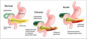 This gland is placed behind the stomach, in close contact with the digestive system and in communication with the liver via the common bile duct. Pancreatitis In Children Symptoms Causes Boston Children S Hospital