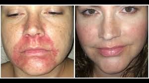 Perioral Dermatitis How I Healed This Unsightly Rash Youtube Perioral Dermatitis Perioral Dermatitis Treatment Perioral