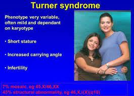 Turner Syndrome