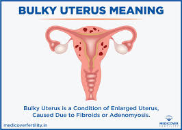 Endometriosis occurs when endometrial tissue grows on your ovaries, bowel, and tissues lining your pelvis. What Is Bulky Uterus It S Symptoms Causes And Treatment