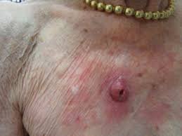 Skin cancer is by far the most common type of cancer. Cutaneous Squamous Cell Carcinoma Knowledge Amboss