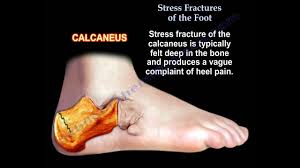 Stress fractures occur in bones that undergo mechanical fatigue. Stress Fractures Of The Foot Everything You Need To Know Dr Nabil Ebraheim Youtube