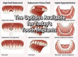 There Are Many Different Options For Replacing Missing Teeth From Single Implant Placement To Multiple Implant Placements Teeth Treatment Dental Mini Implants