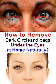 How To Remove Dark Circles And Bags Under The Eyes At Home Naturally Dark Eye Circles Dark Circles Under Eyes Remove Dark Circles